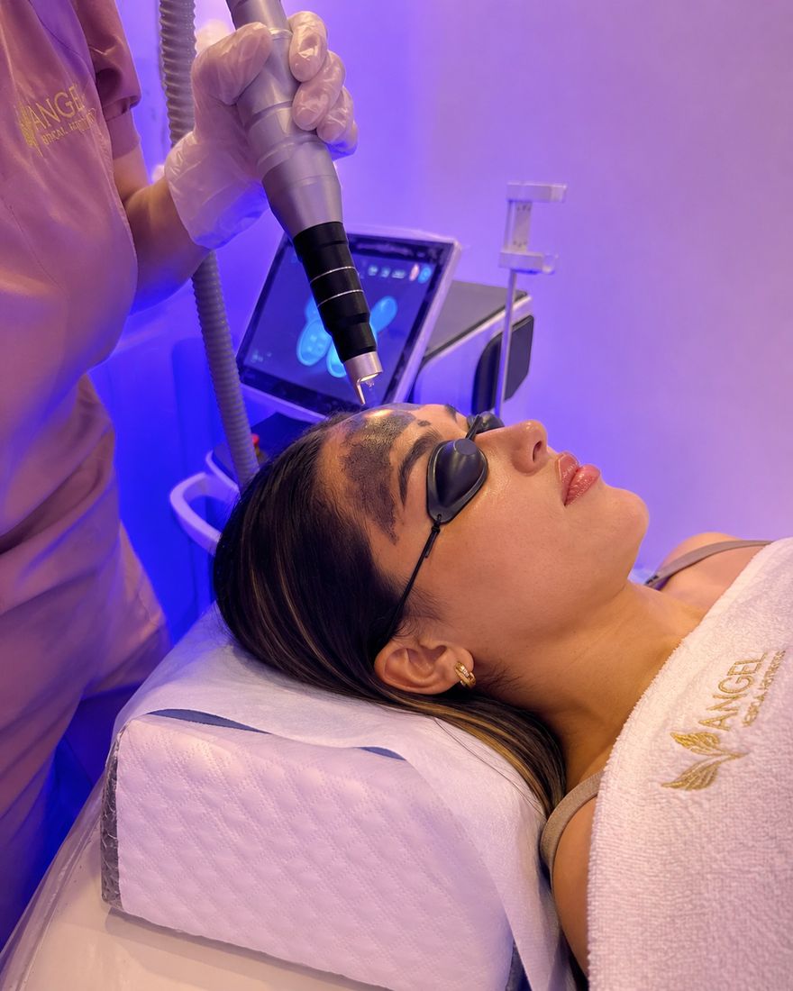 Hollywood Peel en Angel Medical Aesthetic
